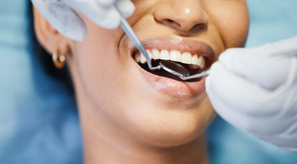 Best Emergency Wisdom Teeth Removal in Flossmoor, IL